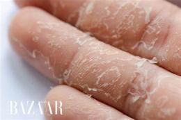 ảnh chụp màn hình da tay bị bong tróc thiếu chất gì