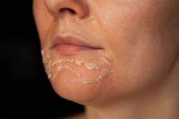 ảnh chụp màn hình peel da đang bong nên làm gì