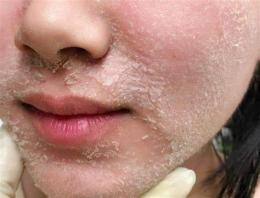 ảnh chụp màn hình sản phẩm peel da bong tróc