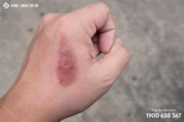 ảnh chụp màn hình vết bỏng bị tróc da nên bôi gì