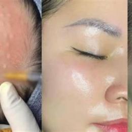 căng bóng da mặt