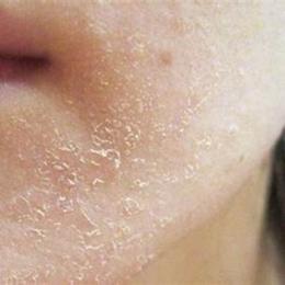 da bị khô bong tróc