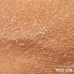 da mặt bị bong tróc vảy trắng