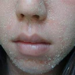 da mặt bong tróc vảy trắng