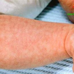 da nổi bông sữa ở người lớn