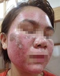 giao diện app da mặt bị bong tróc đỏ rát