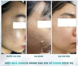 giao diện app peel da đang bong có rửa mặt được không