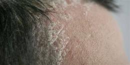 hướng dẫn sử dụng cách trị da đầu khô bong tróc tại nhà