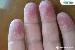 hướng dẫn sử dụng đầu ngón tay bị bong tróc da là bệnh gì