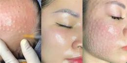hướng dẫn sử dụng tiêm meso căng bóng da