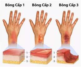 tính năng nổi bật bị bỏng dạ