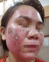tính năng nổi bật da mặt bị bong tróc đỏ rát