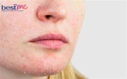 tính năng nổi bật da mặt bong tróc vảy trắng