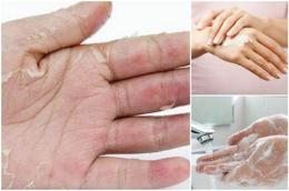 tính năng nổi bật da tay bong tróc