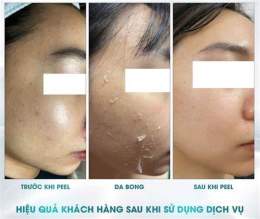 tính năng nổi bật peel da không bong tróc